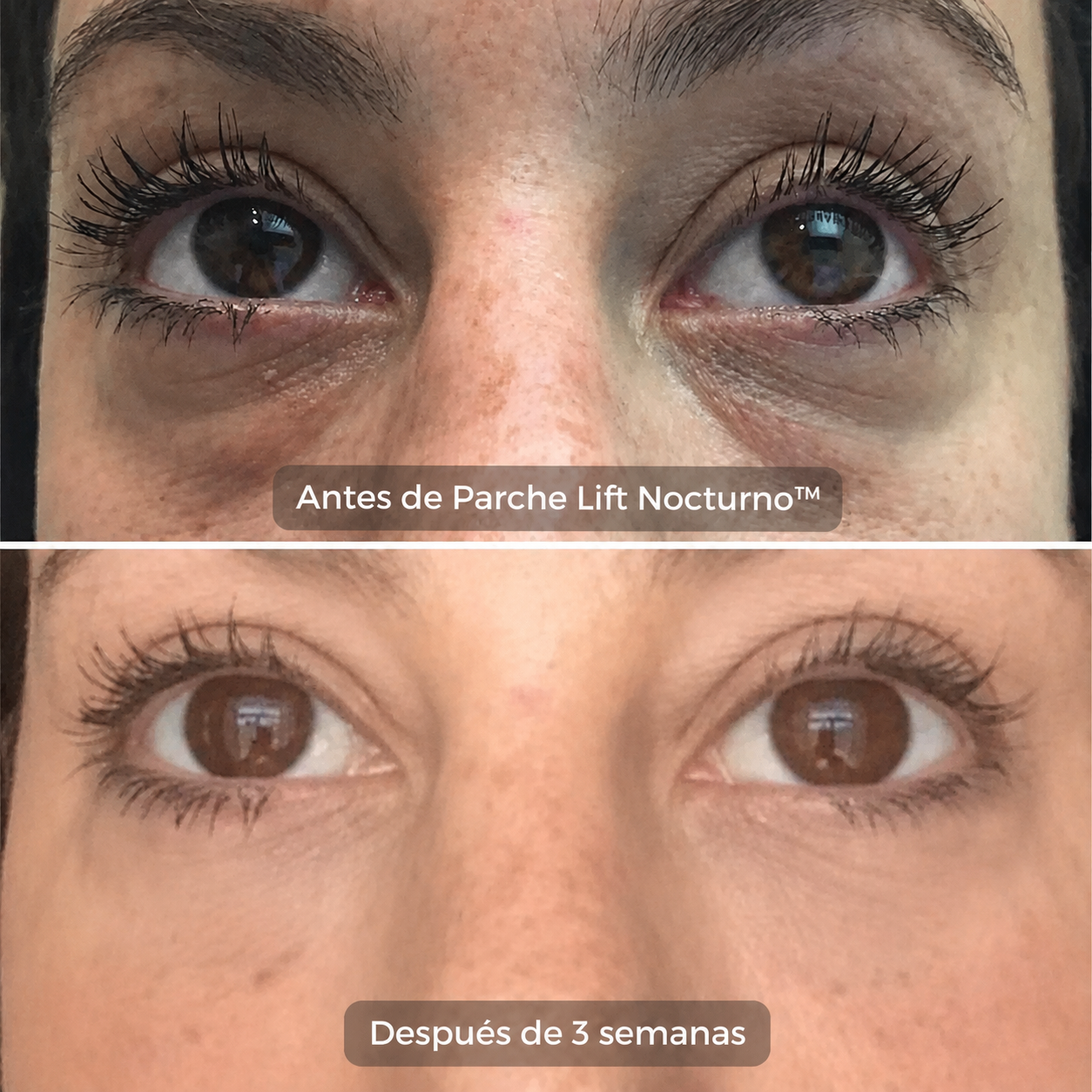 Parche Lift Nocturno™ | Parches de Microagujas para Bolsas y Ojeras