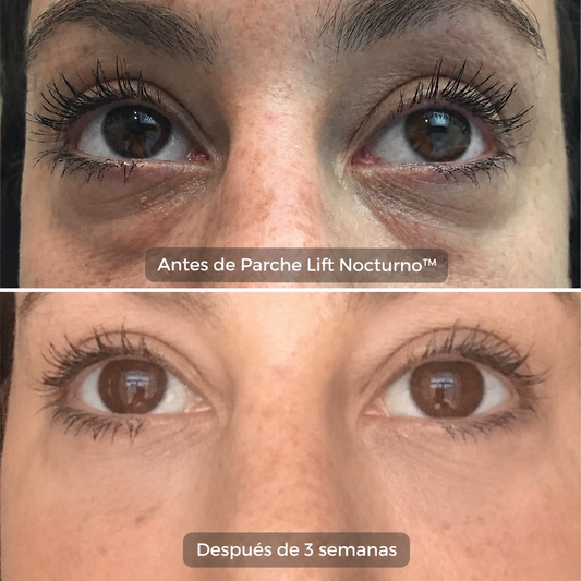 Parche Lift Nocturno™ | Parches de Microagujas para Bolsas y Ojeras
